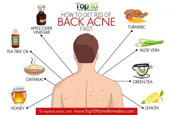 How to Get Rid of Back Acne Fast | Top 10 Home Remedies
