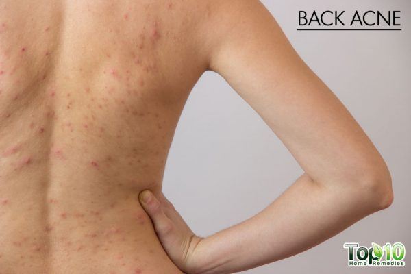back acne symptoms