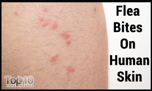 flea bites on human skin