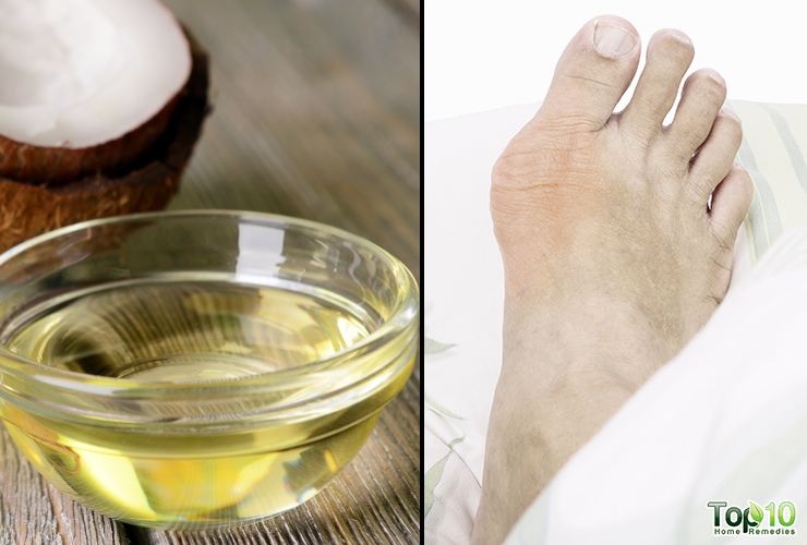 How to Treat Bunions without Surgery Top 10 Home Remedies