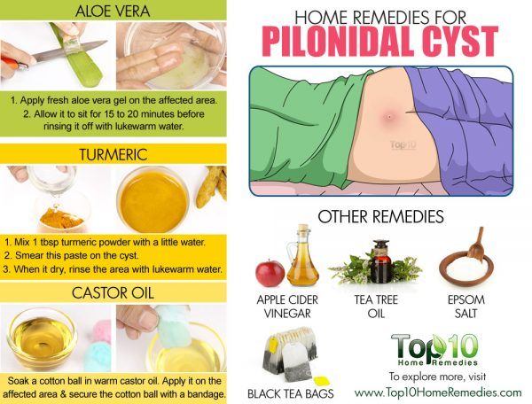 pilonidal cysts home remedies