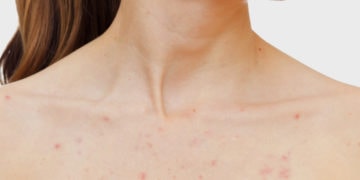Home remedies to get rid of chest acne