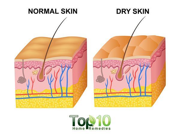 dry skin diagram