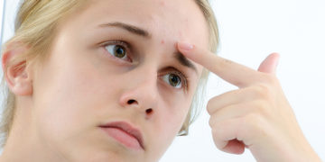 Home remedies to reduce pimple redness