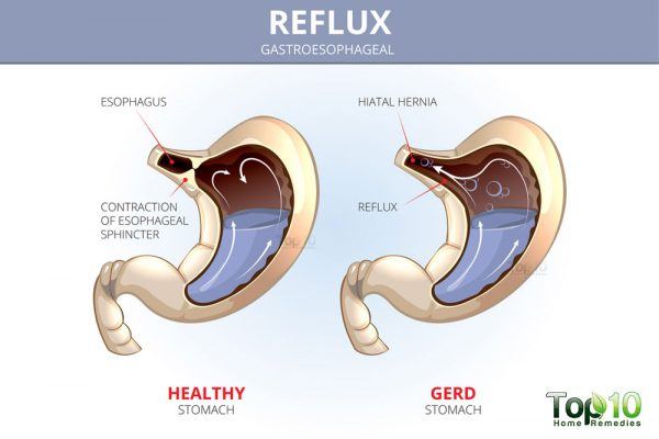 acid reflux diagram