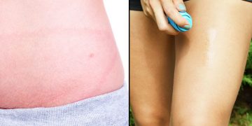 lyme disease signs, symptoms and prevention tips