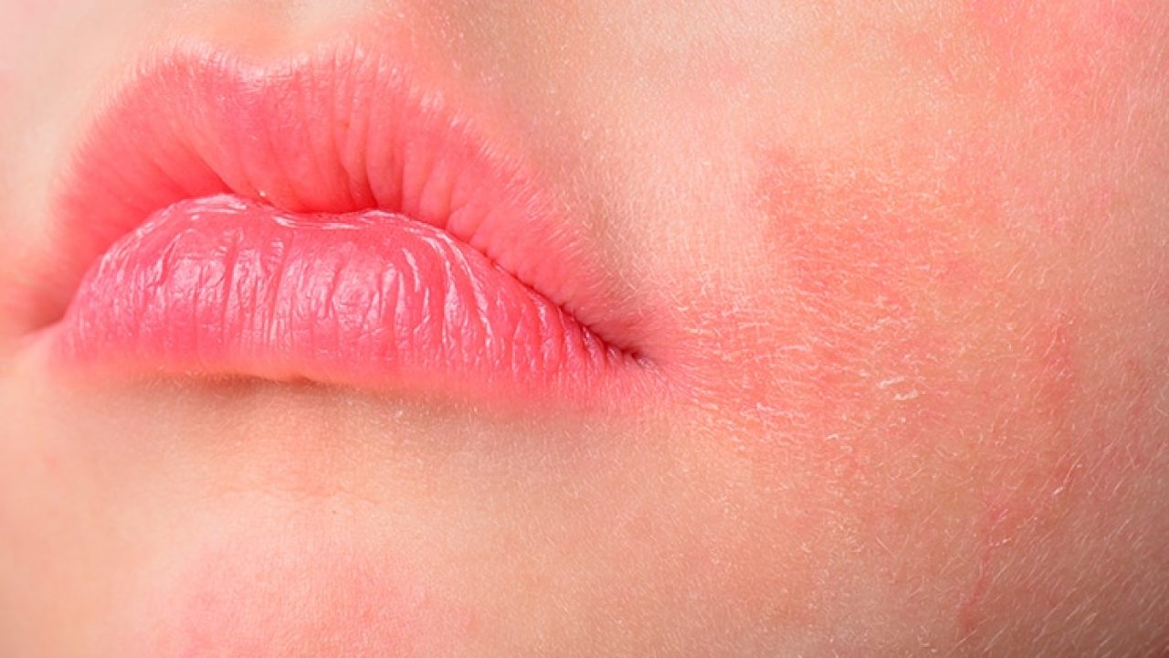 Home remedies for perioral dermatitis