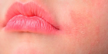 Home remedies for Perioral Dermatitis