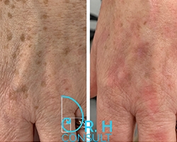 age-spot-1