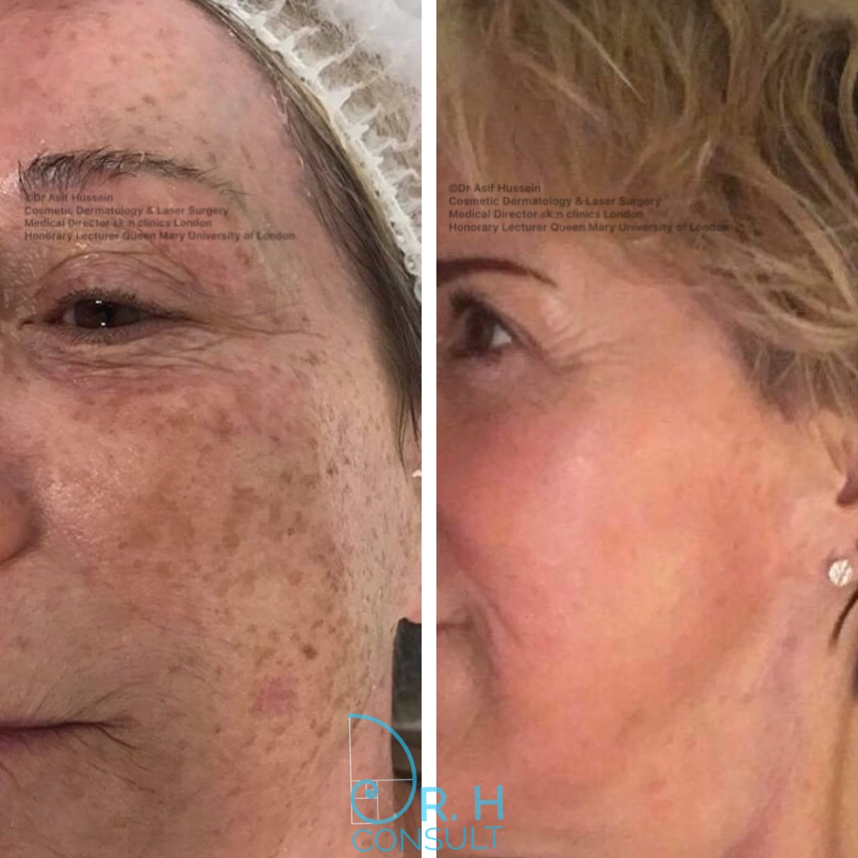 home remedy to fade age spots