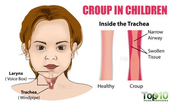 croup in children diagram