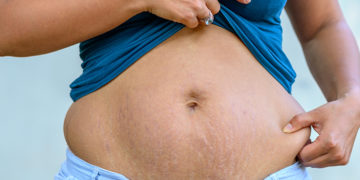loose skin after pregnancy