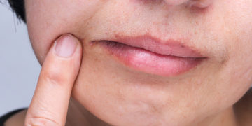 Home remedies for angular cheilitis