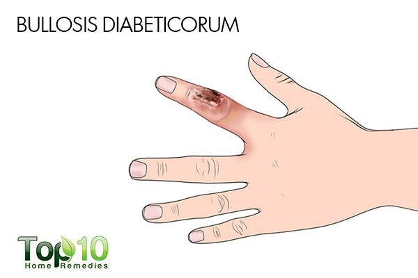 Bullosis Diabeticorum diabetes skin condition