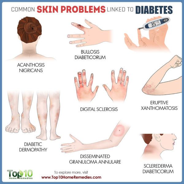 common diabetic skin problems