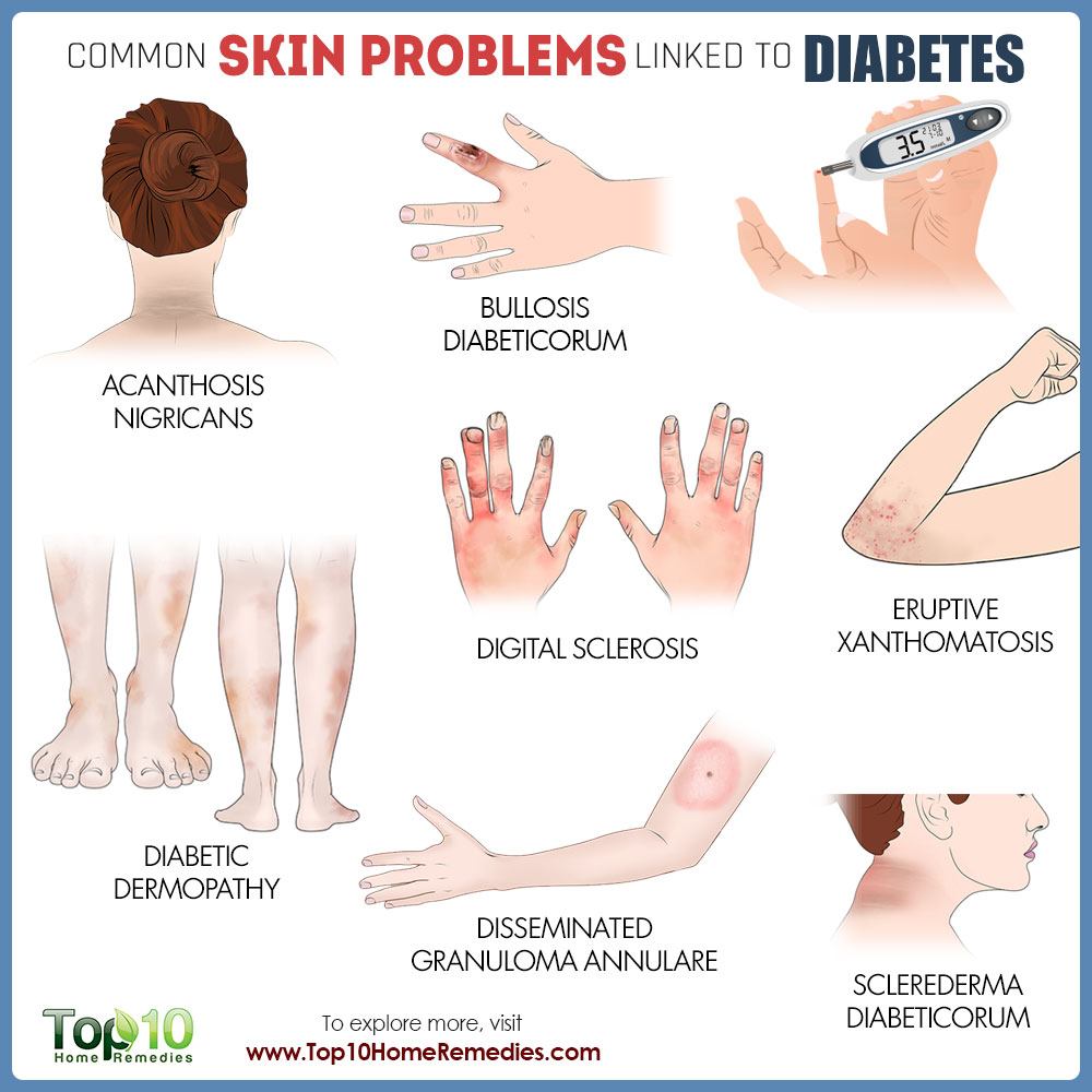 12 Types Of Diabetes Rash And Skin Problems UWNF