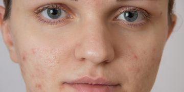 How to Get Rid of Acne Scars