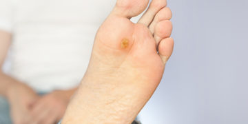 How to get rid of plantar warts
