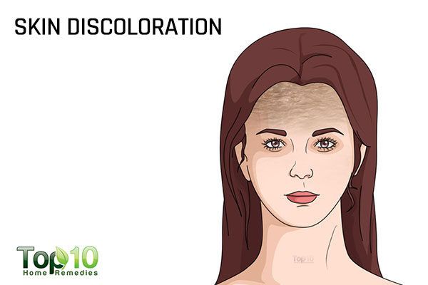 postpartum skin discoloration