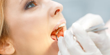 How to remove white spots from your teeth