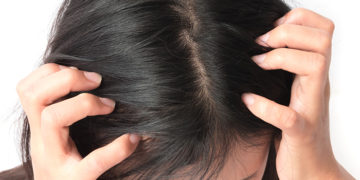 Home remedies for dry scalp