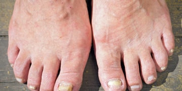 Home remedies for nail psoroasis