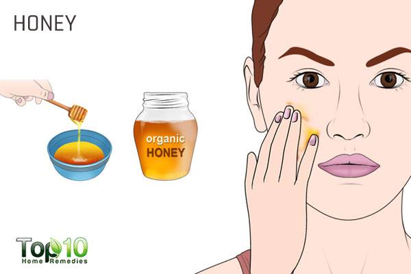 How to Treat Acne during Pregnancy | Top 10 Home Remedies