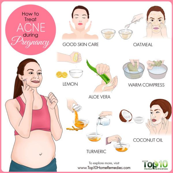 how to treat pregnancy acne