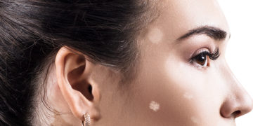 Home remedies for white spots on face