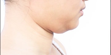 How to get rid of Neck Fat