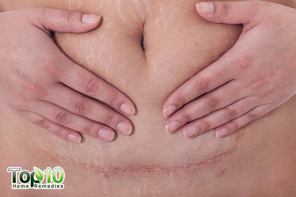 how to recover from a C-section