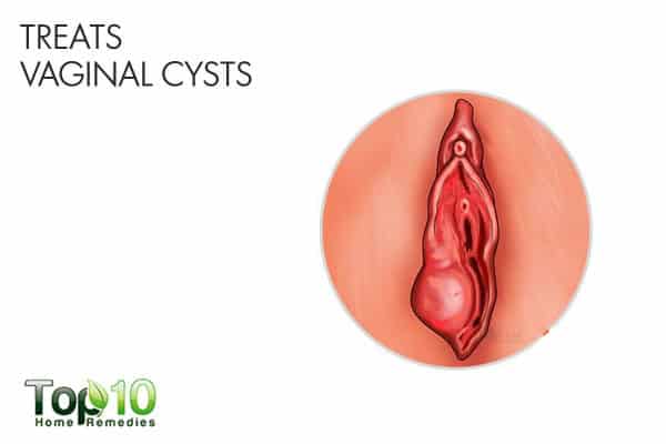 sitz baths for vaginal cysts