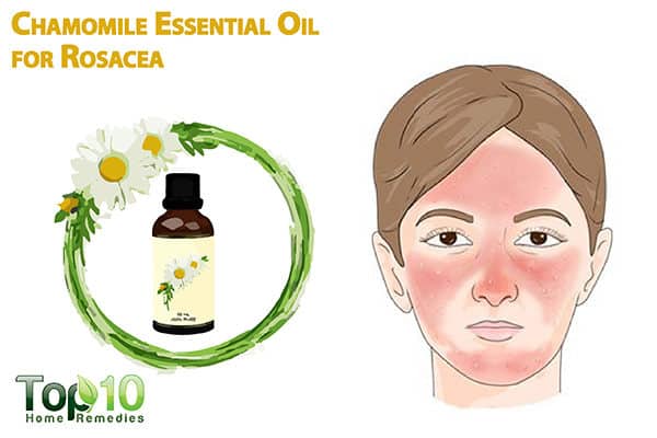 chamomile essential oil for rosacea