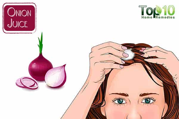 onion juice to prevent balding