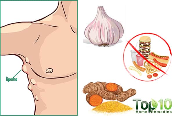 How to Treat Lipoma Naturally | Top 10 Home Remedies