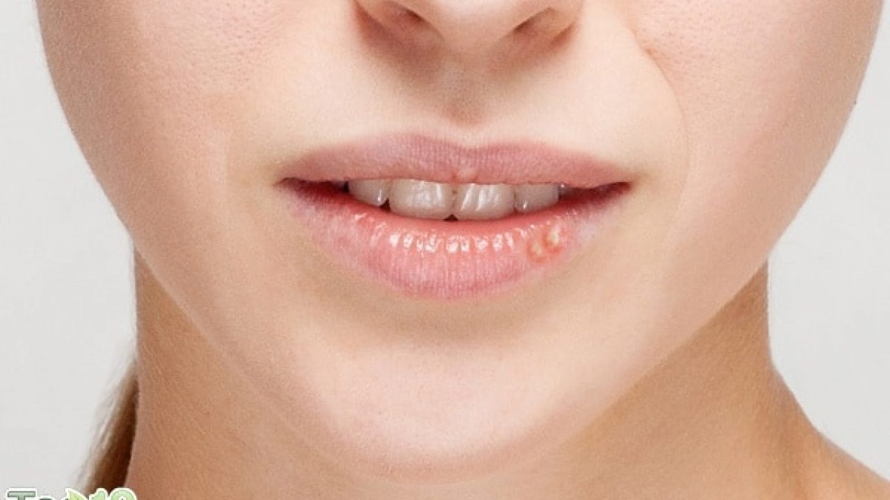 10+ How To Get Rid Of Pimple On Lip PNG  