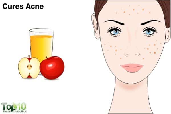 apple cider vinegar treats acne