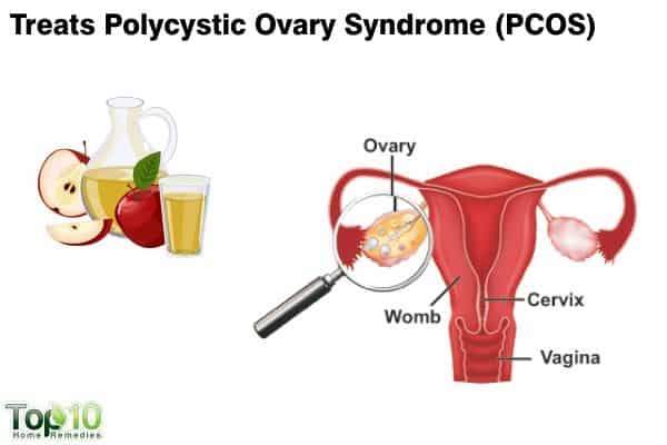 accple cider to manage Polycystic ovary syndrome