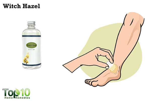 witch hazel to ease jellyfish sting
