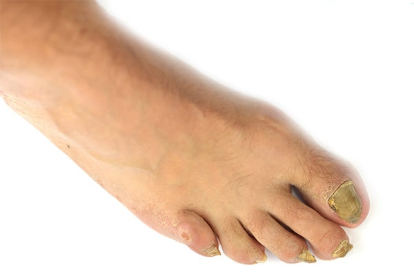 10 remedies to fight toenail fungus at home