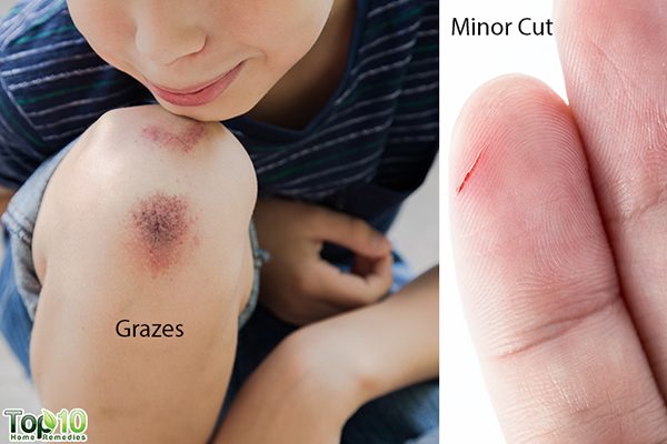 home remedies for minor cuts and grazes